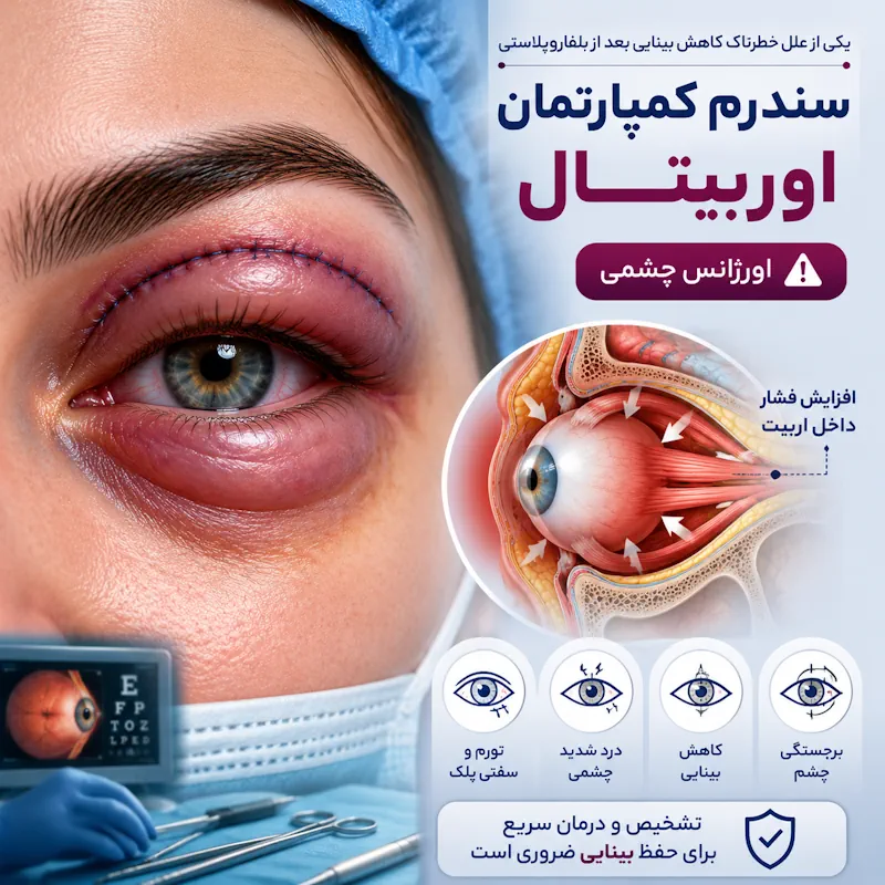 سندرم کمپارتمنت حدقه چشم
